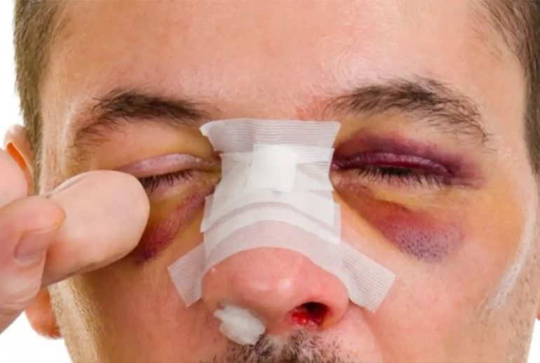 شکستگی بینی